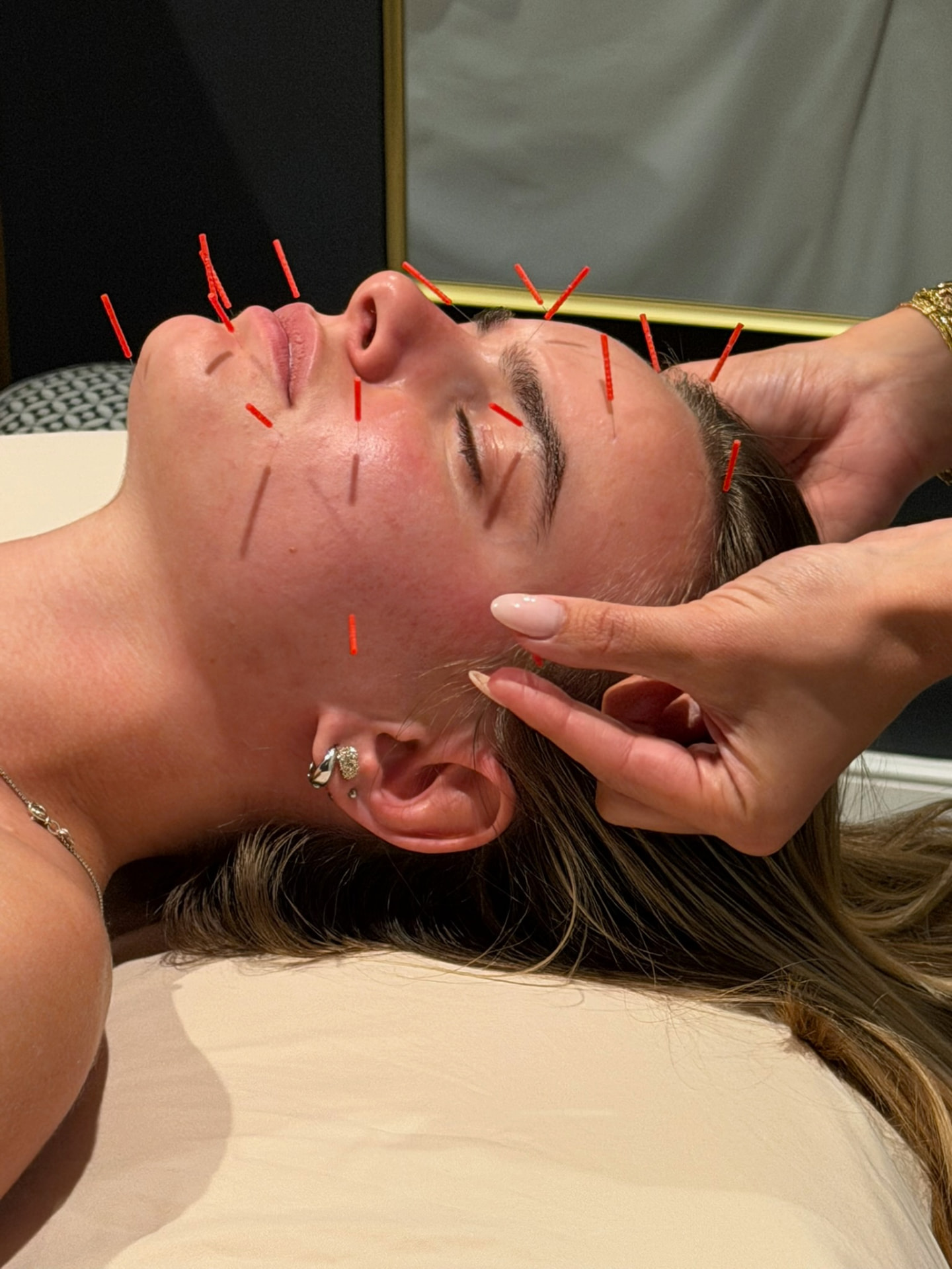 Facial acupuncture treatment